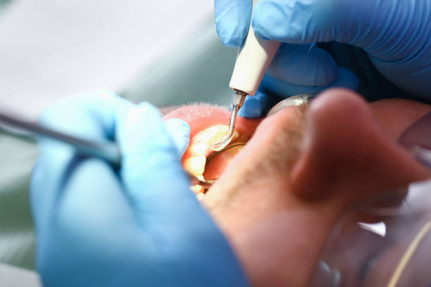 Best Emergency Root Canal Treatment in Horseheads North, NY